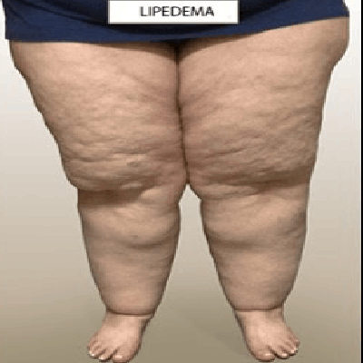 Não é obesidade, é lipedema: o que é e por que convênios não cobrem o  tratamento da doença - Olhar Digital