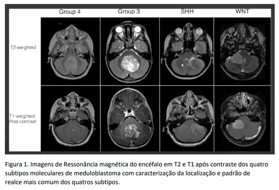 Ressonância Magnética Na Avaliação Dos Tumores Cerebrais Jornal Do Médico®